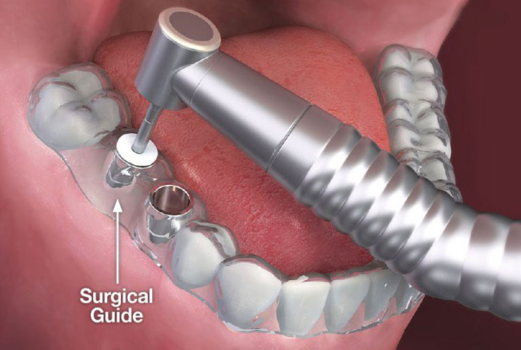 Surgical Guide Implants