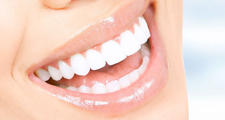 Teeth Whitening