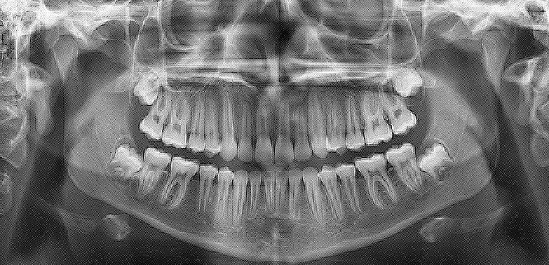 Wisdom Teeth Extractions
